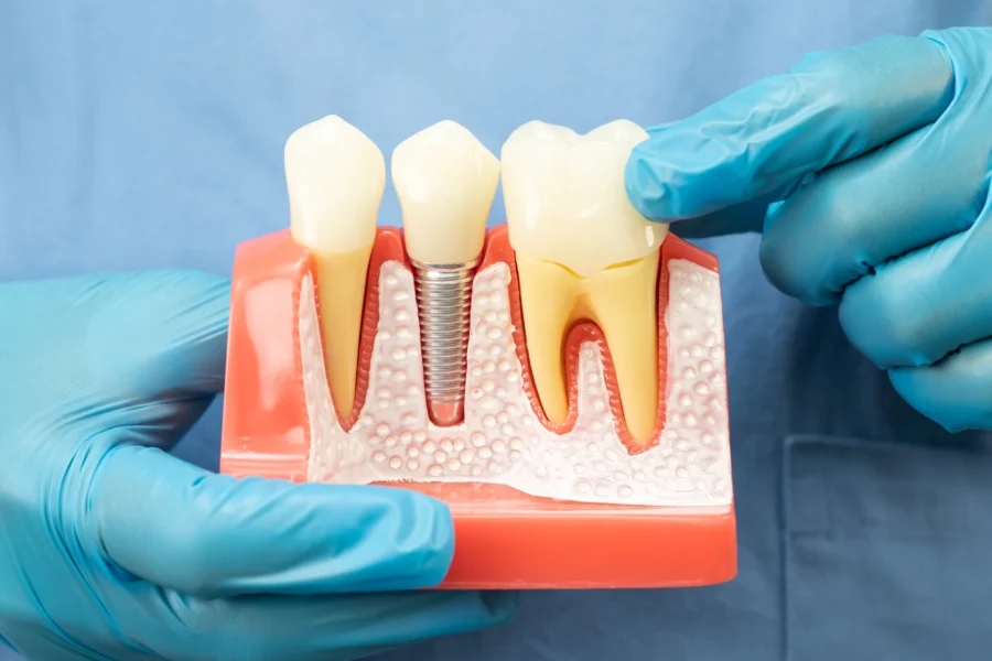 asian-dentist-holding-dental-implant-artificial-t-2026-01-09-09-53-57-utc